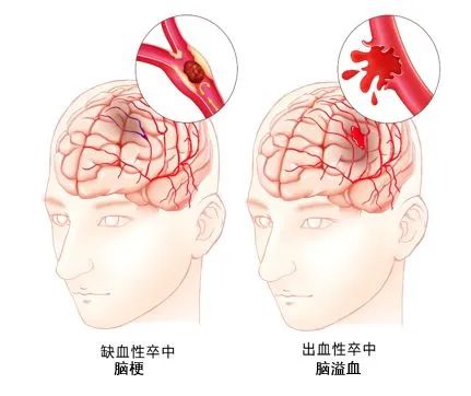 心腦血管疾病應(yīng)該做哪些檢查? 經(jīng)顱多普勒血流分析儀超聲檢查